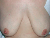 Patient # 18011 Before Photo # 1